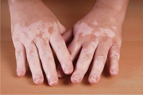 Vitiligo: O que é isso?
